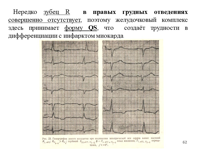 62 Нередко зубец R в правых грудных отведениях 62 Нередко зубец R в правых грудных отведениях